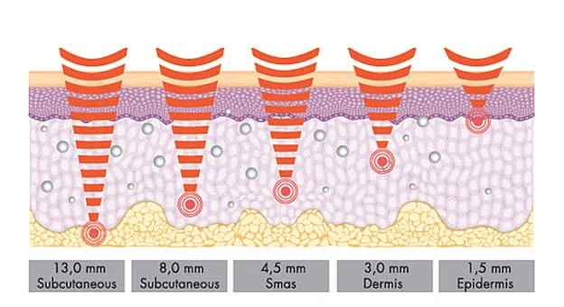 HIFU fat reduction HIFU fat reduction